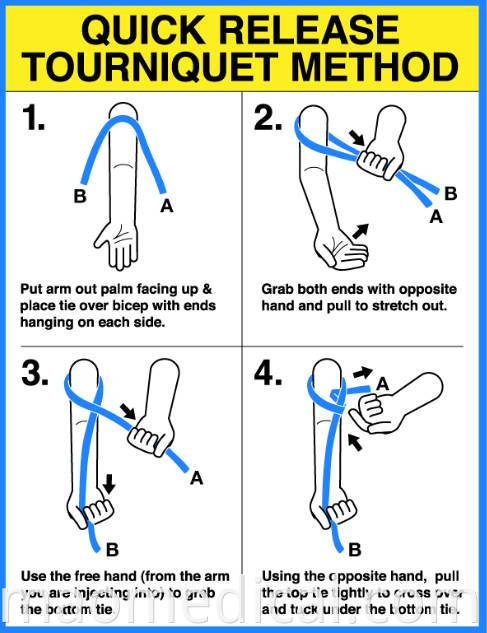 Quick Release Tourniquet Method